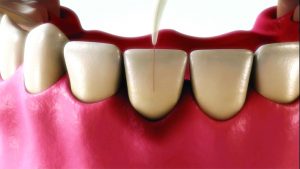 TwinLight Perio procedure