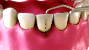 TwinLight Perio procedure