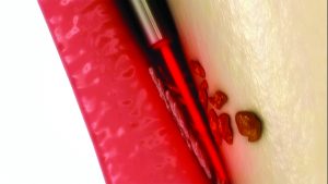 TwinLight Perio procedure