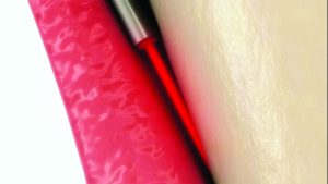 TwinLight Perio procedure