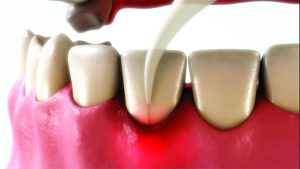 TwinLight Perio procedure